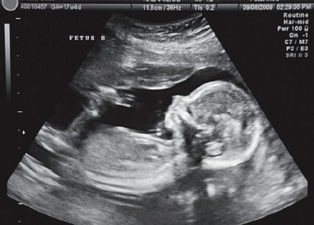 Forma de aborto pone a prueba a m&eacute;dicos